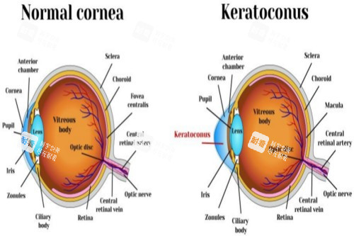 正常眼球结构与圆锥角膜眼球对比