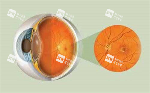 眼底病示意图 眼底病示意图