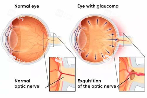 青光眼7 青光眼7
