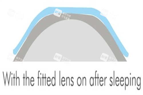 3角膜塑形镜 3角膜塑形镜