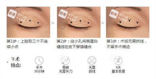 双眼皮三点术过程特点