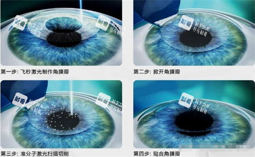 飞秒激光手术示意图 飞秒激光手术示意图