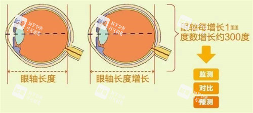 眼轴长度与近视 眼轴长度与近视