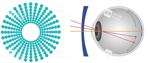 奥拉怒放离焦镜片原理 奥拉怒放离焦镜片原理