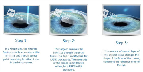 眼睛近视手术的过程 眼睛近视手术的过程