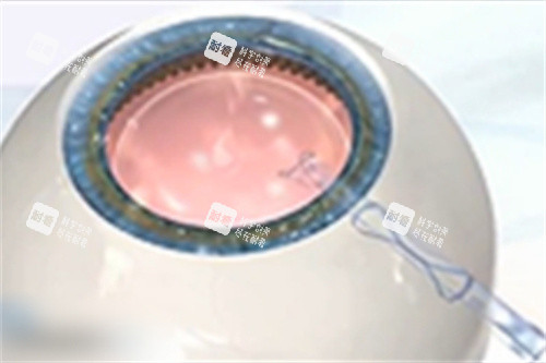 放入ICL晶体 放入ICL晶体