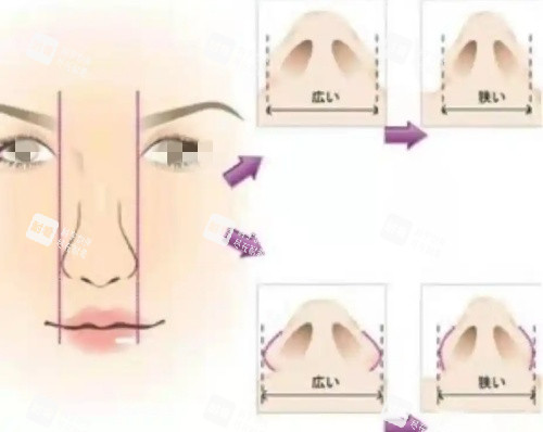 鼻骨内推操作步骤示意图 鼻骨内推操作步骤示意图