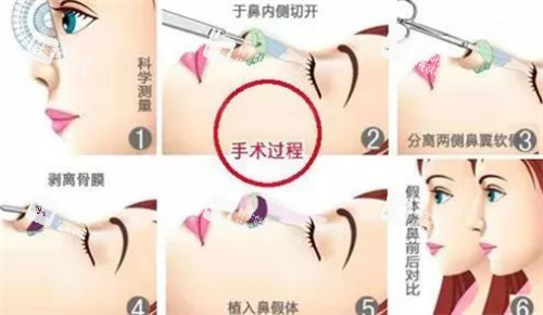 隆鼻过程图解 隆鼻过程图解