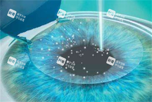 绿飞秒近视手术过程图解