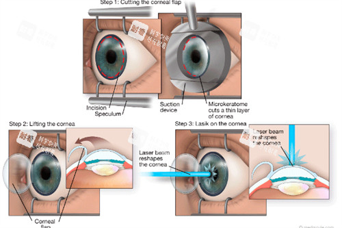 近视手术操作过程图解 近视手术操作过程图解