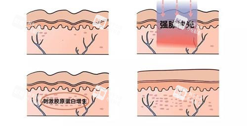 光子嫩肤的祛斑过程