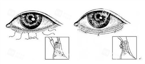倒睫手术过程示意图