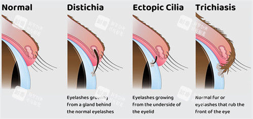 不同程度的倒睫