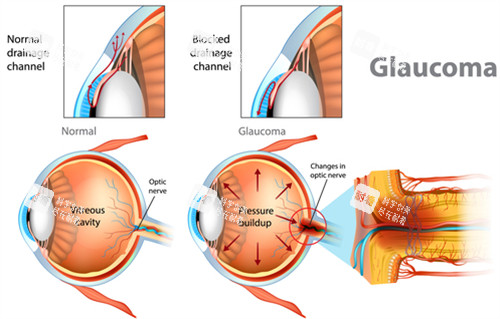 正常眼镜和青光眼内部区别