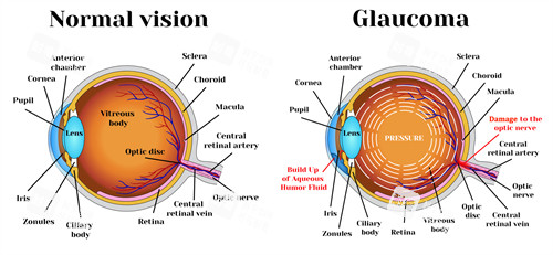 青光眼结构