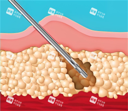 吸脂手术皮肤层 吸脂手术皮肤层