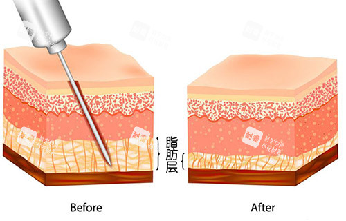 吸脂手术层级示意图 吸脂手术层级示意图
