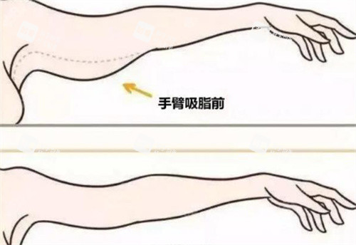 手臂吸脂 手臂吸脂