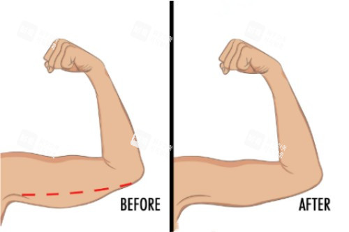 手臂吸脂对比图 手臂吸脂对比图