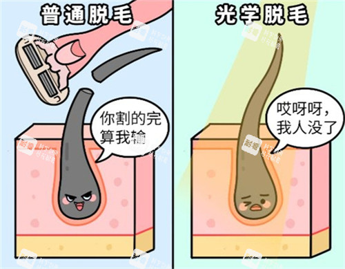 激光脱毛和普通刮毛的区别