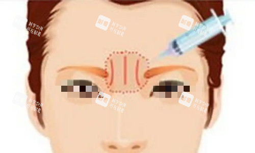 川字纹注射示意图