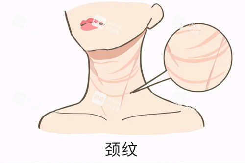 颈纹卡通示意图