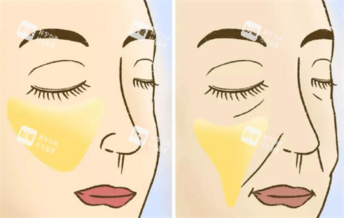 苹果肌提升前后对比