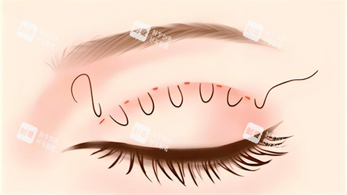 双眼皮埋线图 双眼皮埋线图