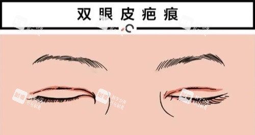 双眼皮疤痕修复动画图