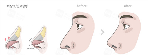 隆鼻前后对比图 隆鼻前后对比图