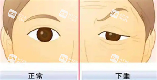上睑下垂对比图