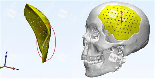 颅骨修复动画图