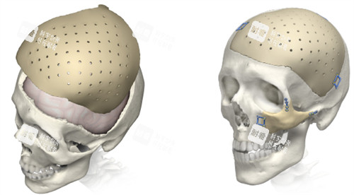 颅骨修复对比