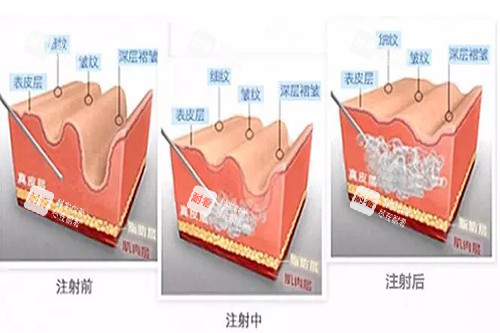 玻尿酸注射皮肤内在过程示意图 玻尿酸注射皮肤内在过程示意图