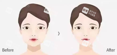 面部轮廓整形前后对比图