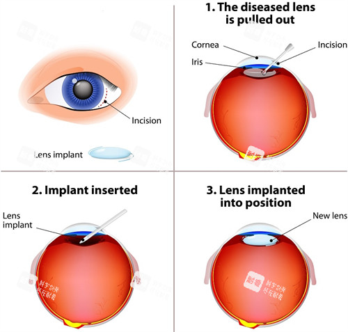 晶体植入手术过程