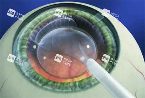 晶体植入手术图