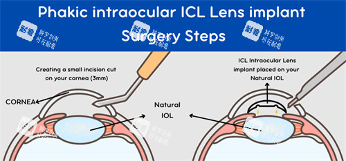想做晶体植入怕贵？上海新视界日常优惠2500元，非散光晶体31100元起