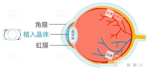近视眼卡通图示