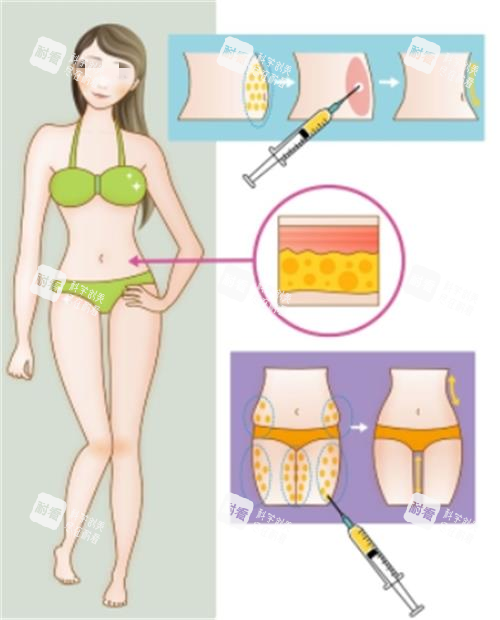 全身吸脂部位示意图 全身吸脂部位示意图