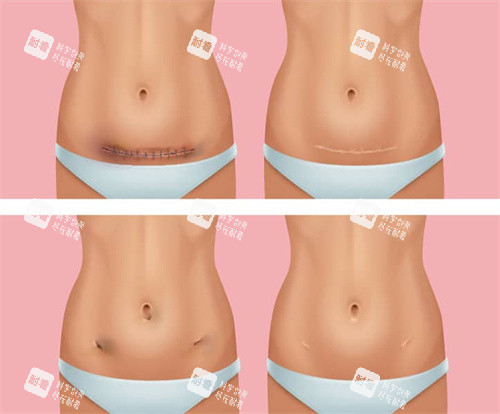 剖腹产疤痕修复过程 剖腹产疤痕修复过程