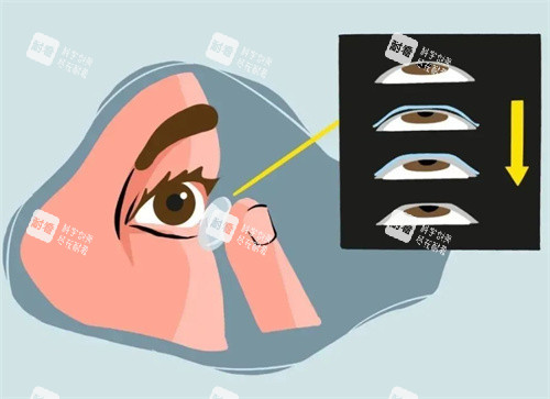 OK镜佩戴 OK镜佩戴