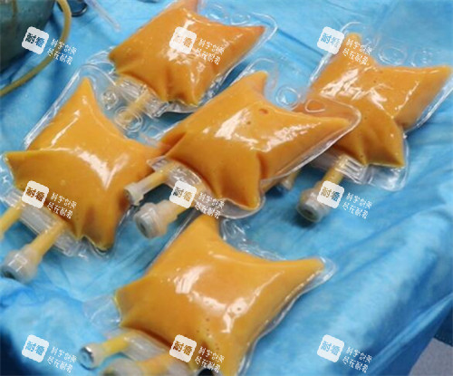 刘成胜脂肪丰胸展示图