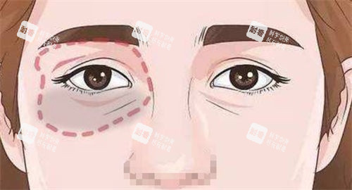泪沟眼袋画线展示图