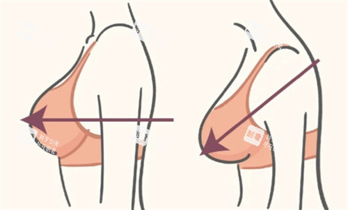 缩胸手术术前术后