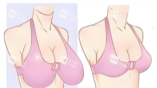 巨乳缩小对比卡通图