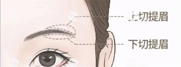 提眉术