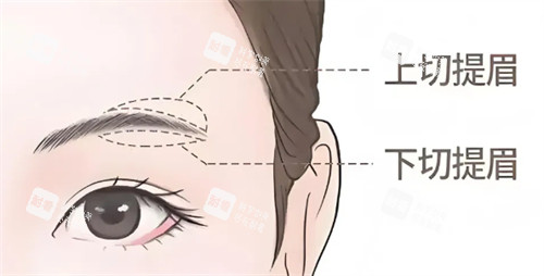提眉术式区别