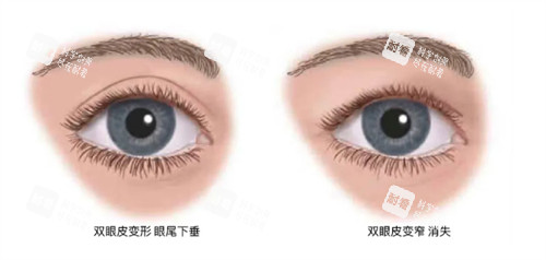 什么情况下要提眉