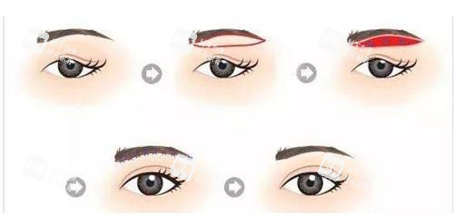 提眉手术步骤示意图